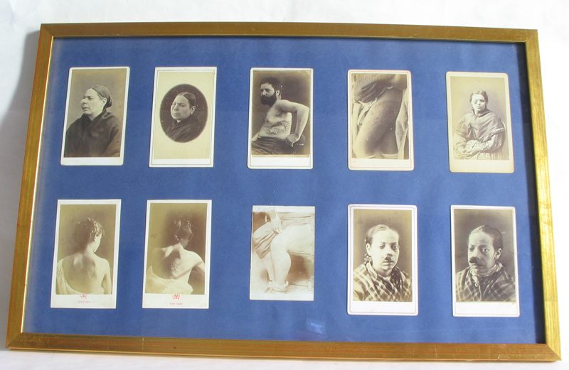 Malalts amb diferents processos clínics. Fotografies realitzades pel Dr. Jaume Ferran a Tortosa ca. 1880.